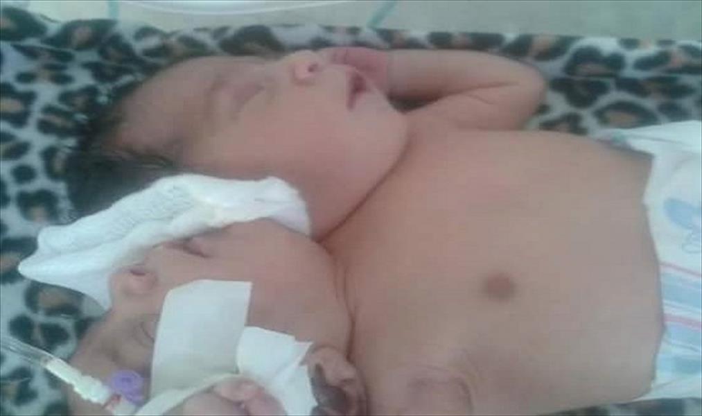 أول ولادة نادرة لتوأم سيامي ملتصق بمستشفى البيضاء‎