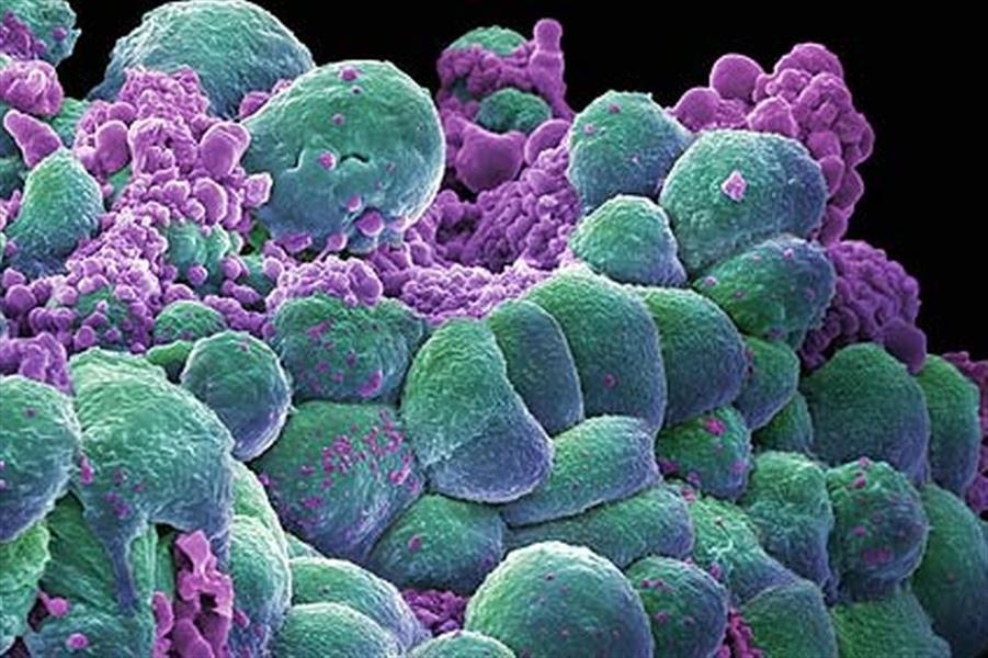 علماء يكشفون سر انتشار الأورام السرطانية