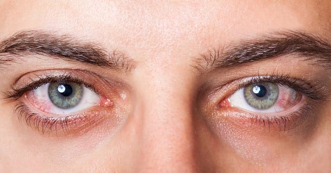ثماني علامات للعينين تشير إلى وجود أمراض بالجسم