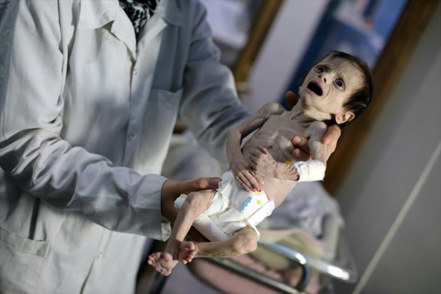 سوء التغذية..موت بالبطيء لأطفال الغوطة الشرقية المحاصرة بسورية