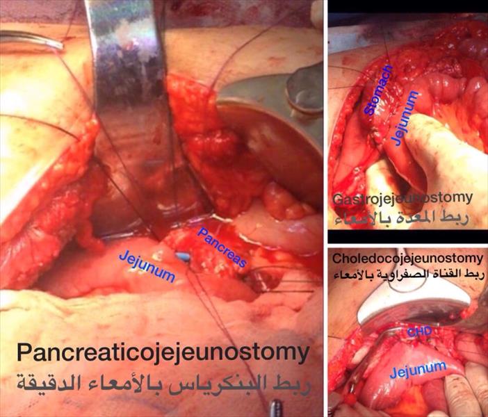 إجراء جراحة دقيقة لاستئصال ورم سرطاني بمستشفى الجلاء في بنغازي