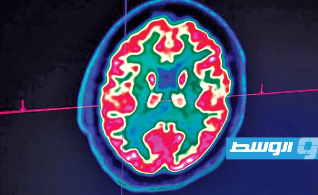 أعراض جديدة تكشف كيف يمكن أن يؤثر «كوفيد-19» على الدماغ