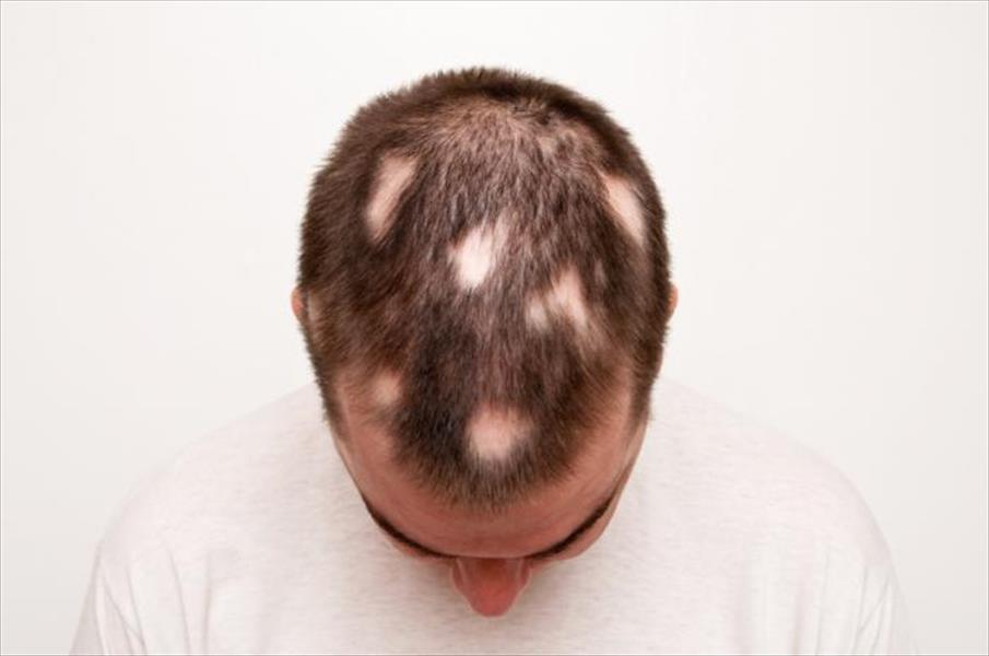 دراسة تقترح تقنية علاجية جديدة لتساقط الشعر