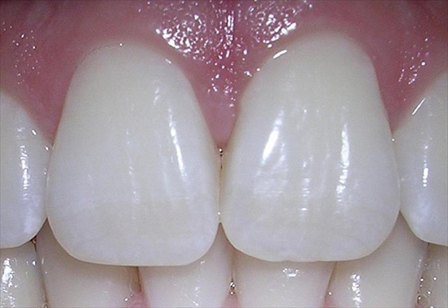 علاج جديد للأسنان الحساسة