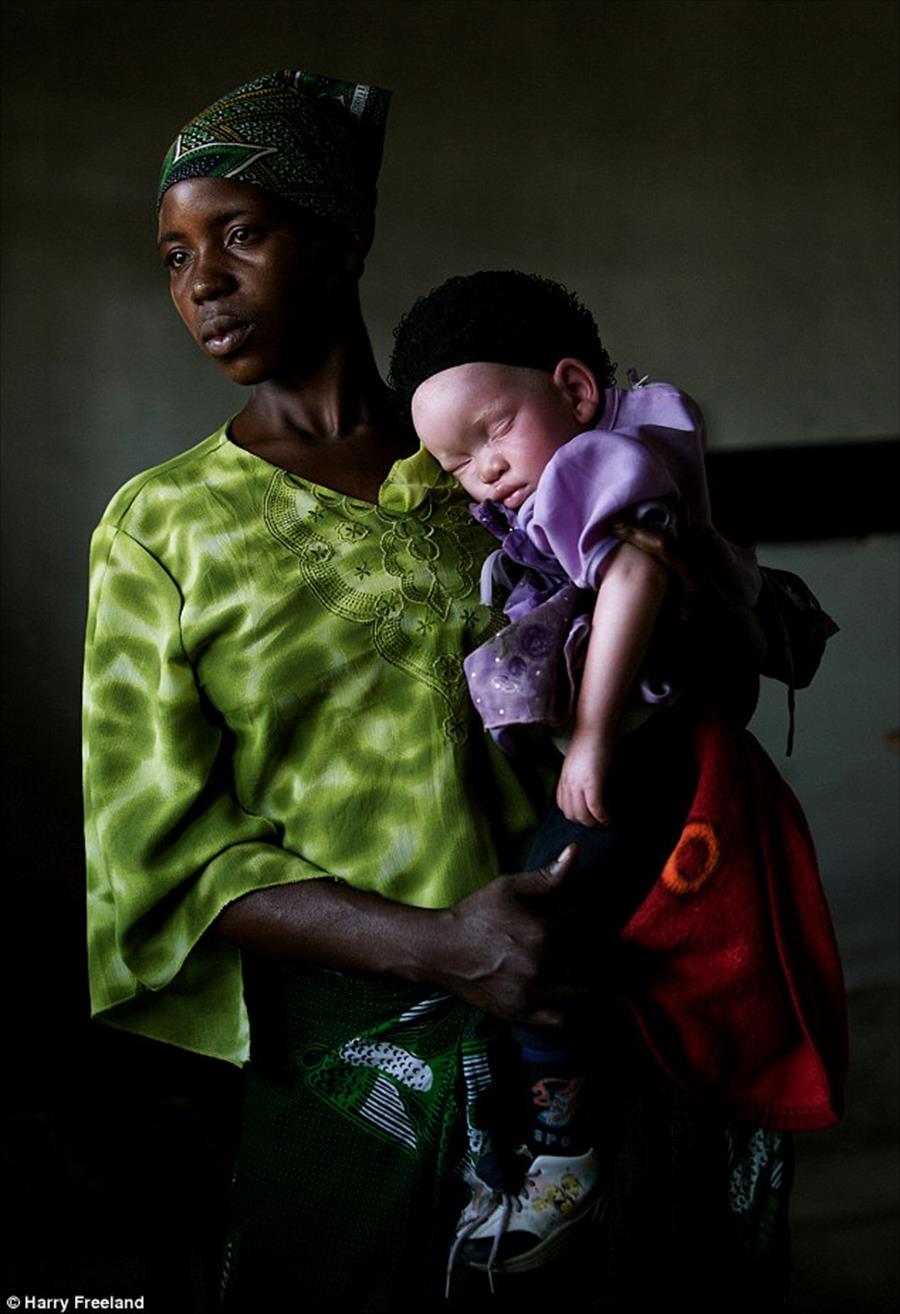 الاتجار بـ«أعداء الشمس» في تنزانيا: مصابون بالمهاق للبيع (صور)