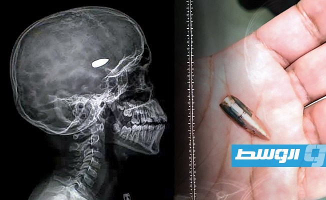 إزالة «رصاصة عشوائية» اخترقت دماغ طفل في بنغازي