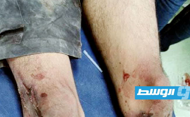 آثار تعذيب بادية على شخص تعرض للاحتجاز والتعذيب في مصراتة، 9 يوليو 2023. (مكتب النائب العام)