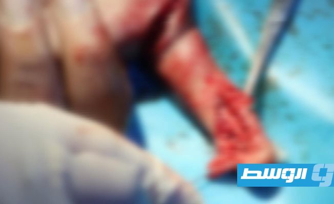 أحد الجرحي يتلقي العلاج بمستشفى الحروق في طرابلس، 28 أكتوبر 2020. (صحة الوفاق)