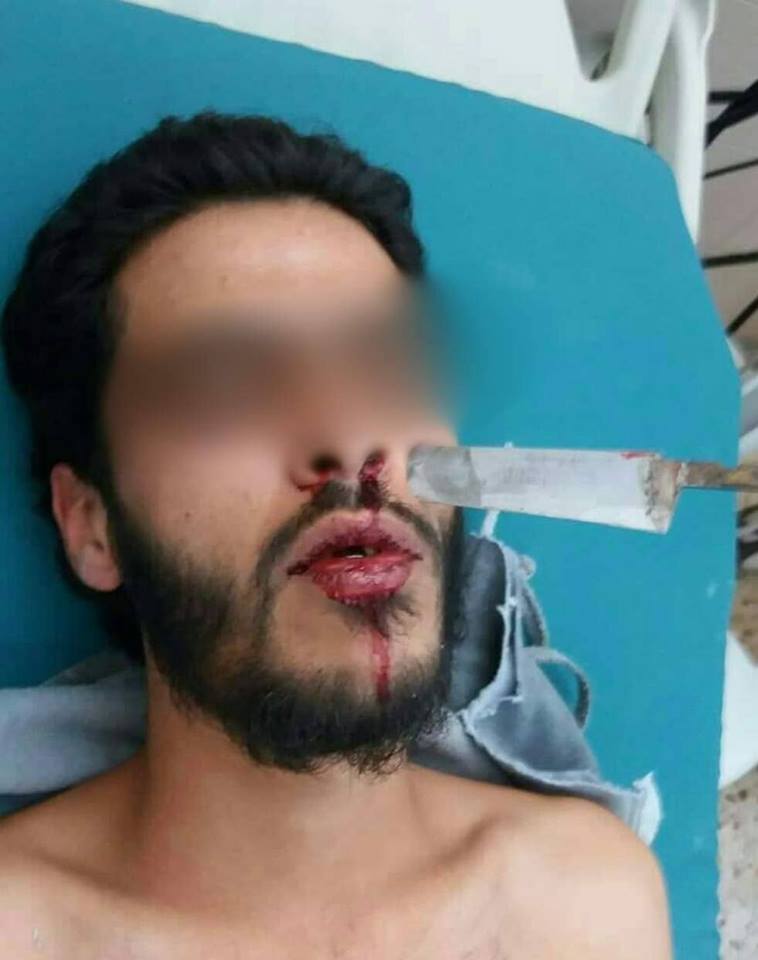 مستشفى الجلاء: إزالة سكين من وجه شاب أصيب به في بنغازي