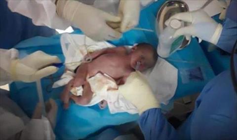 ولادة طفلين من مصابتين بفيروس «كورونا» في «مركز العزل الصحي 1» بمصراتة