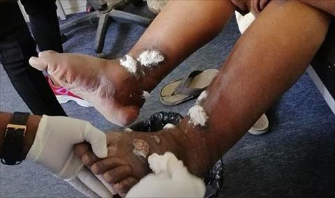 مصابون باللشمانيا يتلقون العلاج في مستشفى تاورغاء العام، 22 نوفمبر 2019 (فرانس برس)