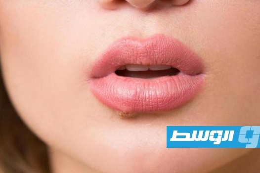 وصفة طبيعية للقضاء على البثور حول الفم