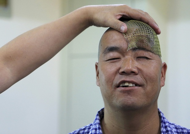 صيني يستعيد نصف دماغه بطابعة ثلاثية الأبعاد