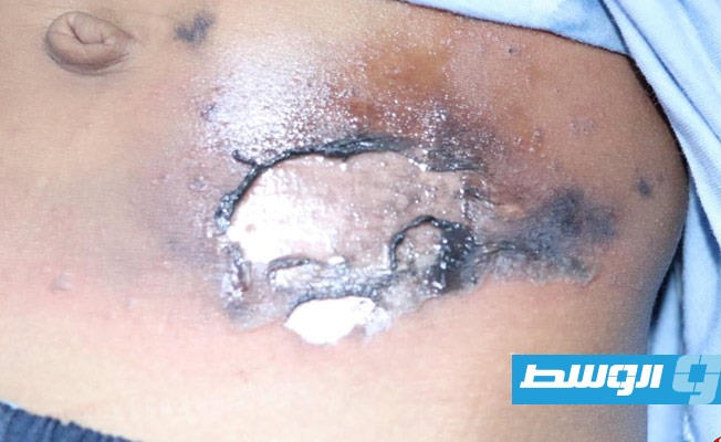 أحد الجرحي يتلقي العلاج بمستشفى الحروق في طرابلس، 28 أكتوبر 2020. (صحة الوفاق)