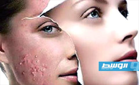 علاج حبوب الوجه بالأسبرين