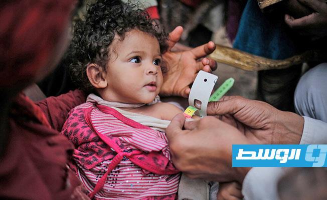 تحذير أممي من ارتفاع معدلات سوء التغذية الحاد بين أطفال اليمن