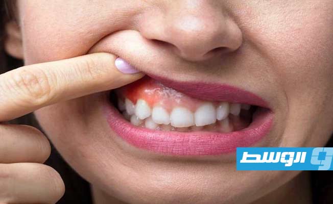 دراسة تكشف العلاقة بين بكتيريا الفم والأمراض القاتلة