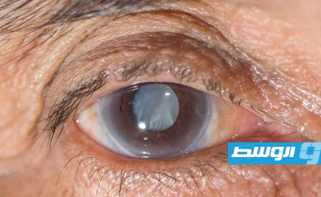 ثاني سبب يؤدي للعمى في ليبيا.. كل ما تحتاج معرفته عن «الغلوكوما»