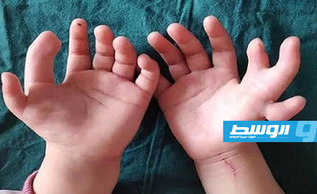 جراحة ناجحة لطفلة تمتلك 14 إصبعًا في يديها