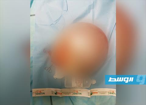 عملية استئصال كيس يزن 15 كيلو غرامًا بمركز بنغازي الطبي