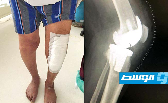 نجاح عملية استبدال مفصل ركبة بمستشفى جالو المركزي