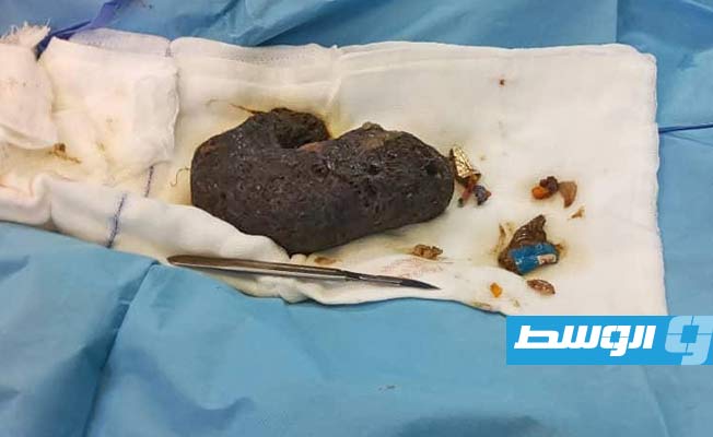 شعر وأجسام غريبة مستخرجة من باطن الطفلة, (مستشفى ترهونة التعليمي)