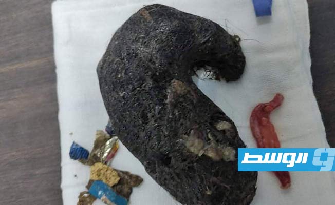 شعر وأجسام غريبة مستخرجة من باطن الطفلة, (مستشفى ترهونة التعليمي)